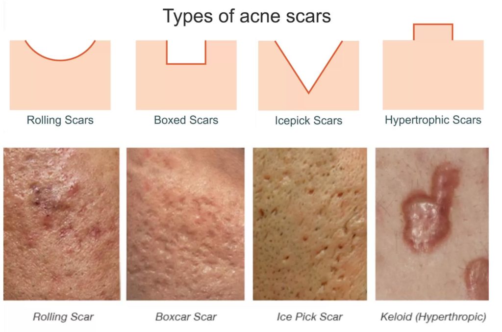 Types of acne scars