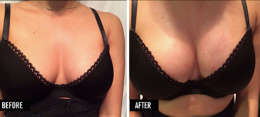 prp breast life before after malaysia
