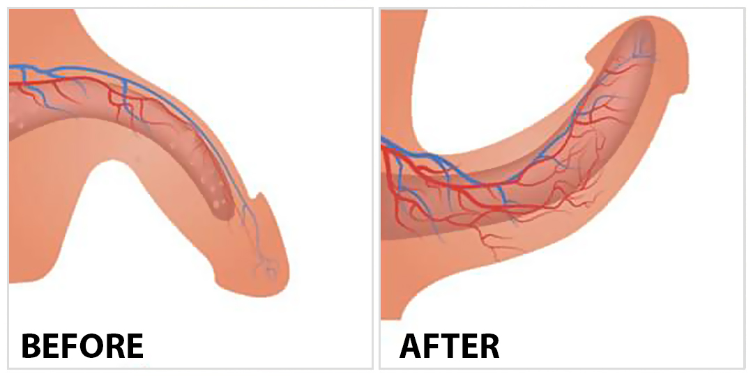 P Shot for Sexual Rejuvenation STELLAR CLINIC