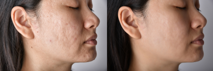 acne scar treatment melaka
