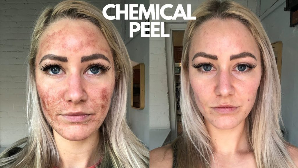 Chemical Peel STELLAR CLINIC